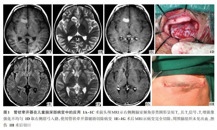 【萊沃醫(yī)療：文獻(xiàn)解讀】一次性使用腦部牽開導(dǎo)引導(dǎo)管在兒童腦深部病變的應(yīng)用研究