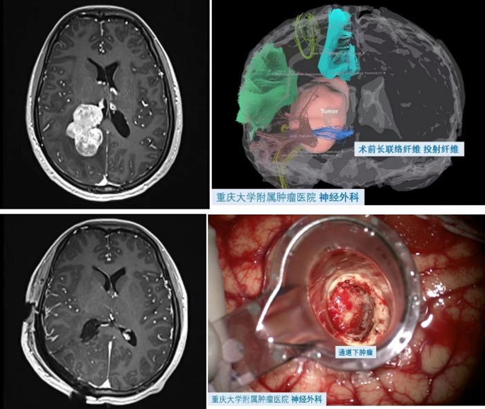 【萊沃醫(yī)療：病例分享】重慶大學(xué)附屬腫瘤醫(yī)院神經(jīng)外科Endoport下切除三角區(qū)巨大腦膜瘤